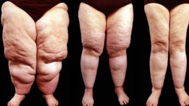 Pesquisadores da USP São Carlos abrem segunda chamada para tratamento experimental de lipedema