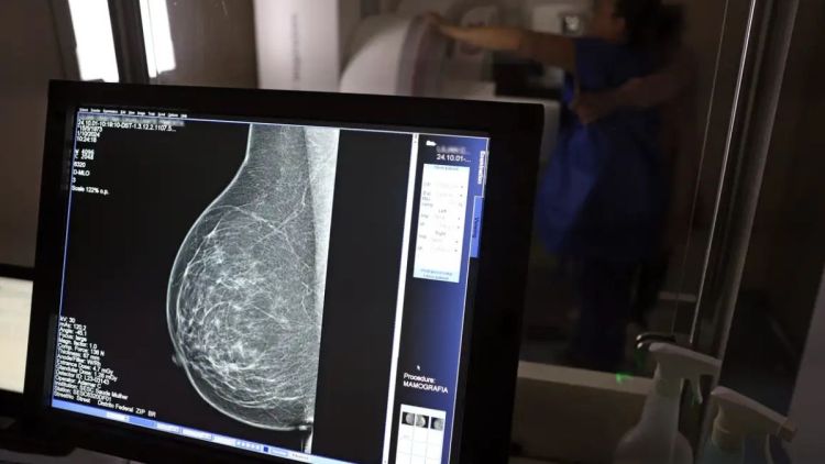Câncer de mama: uma em cada três pacientes tem menos de 50 anos