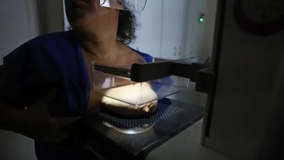 ANS defende que plano cubra mamografia digital sem restrição de idade